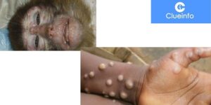 What is Monkeypox? Monkeypox Causes, Symptoms, Treatment, and Prevention